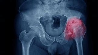 Hip arthritis! 